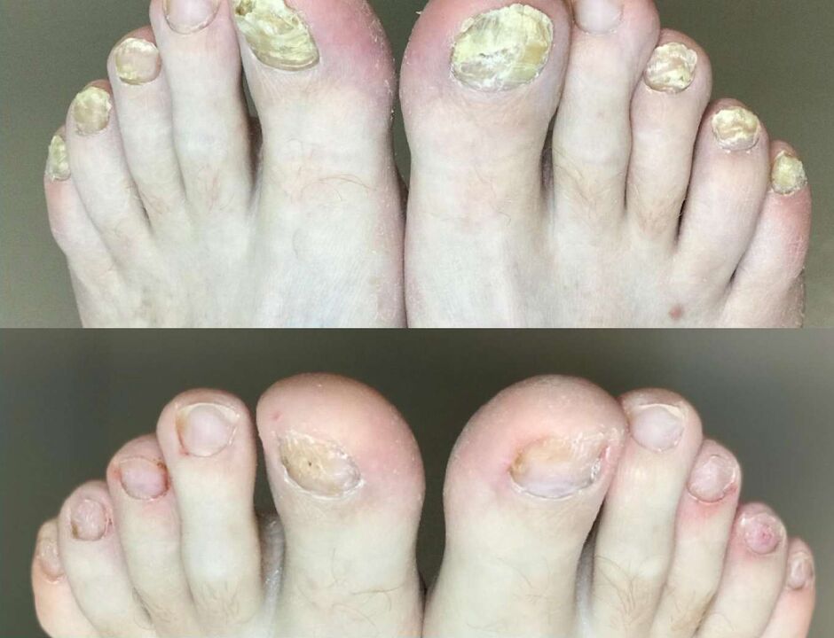 Before and after treatment, Fungus Promisil Cream