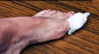 Compressed to treat fungus on the thumb of the leg