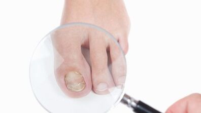 How to treat a mushroom on the thumb of the leg