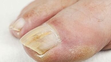 Reasons for the appearance of mushrooms on the thumb of the leg