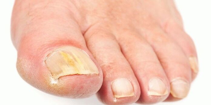 Effective products from nail mushrooms