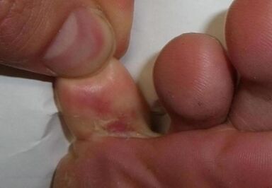 Cracked toes due to fungal infection