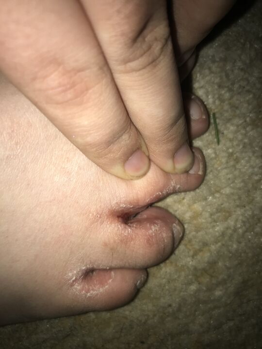 Toe fungus infection