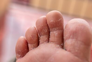 symptoms of toe fungus