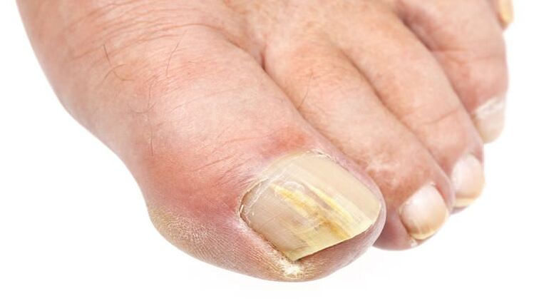 Changes in the appearance of the nails are a sign of a fungal infection