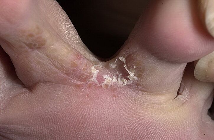 Cracked skin between the toes is a symptom of interstitial fungus