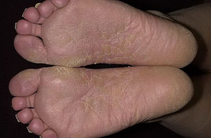 Dry, peeling foot skin is a sign of athlete's foot