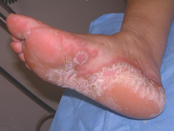 Feet are infected with fungus