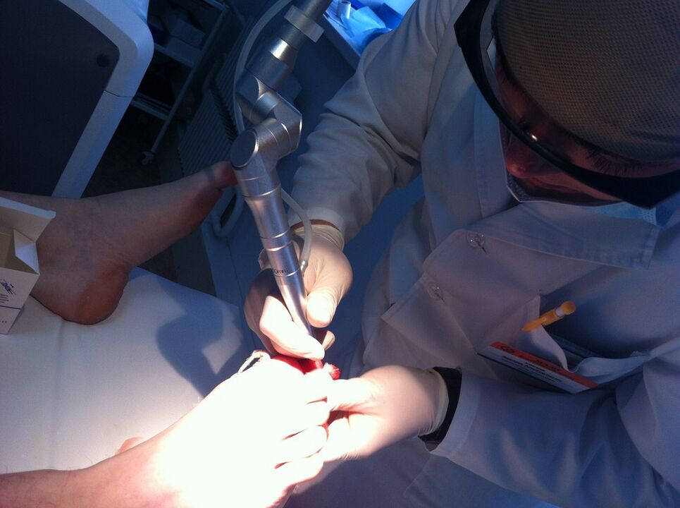 Laser mycosis