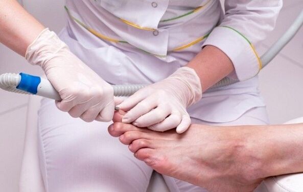 Toenail fungus treatment process